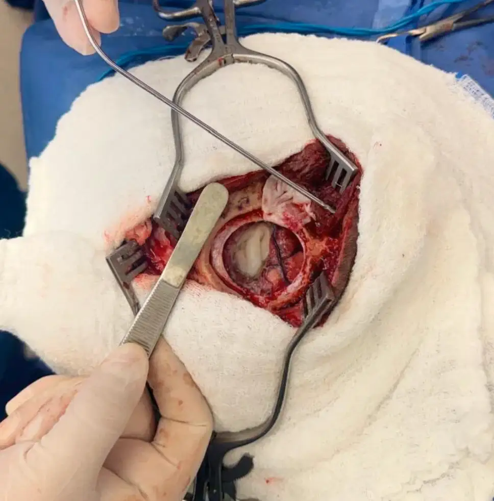 Resección tumores cerebrales — foto 3
