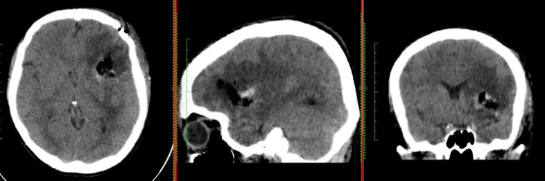 Resección tumores cerebrales — foto 4