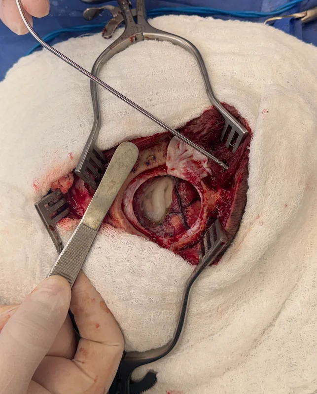 Resección de tumor cerebral — lesión occipital derecha