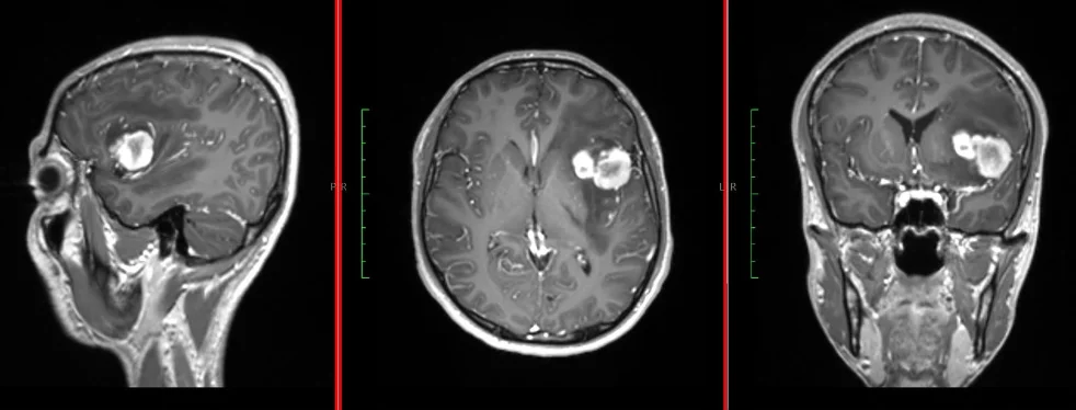 Resección tumores cerebrales — foto 1