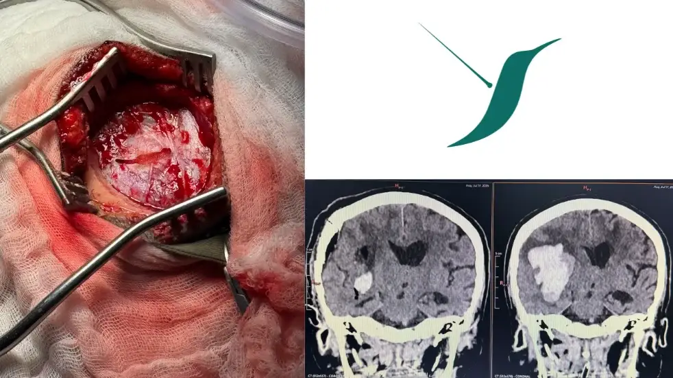 Hematomas intracerebrales — foto 3