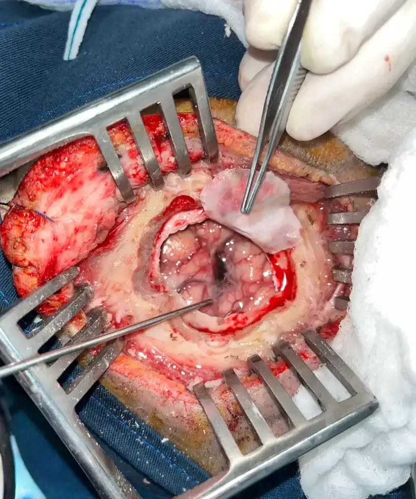 Hematomas intracerebrales — foto 4