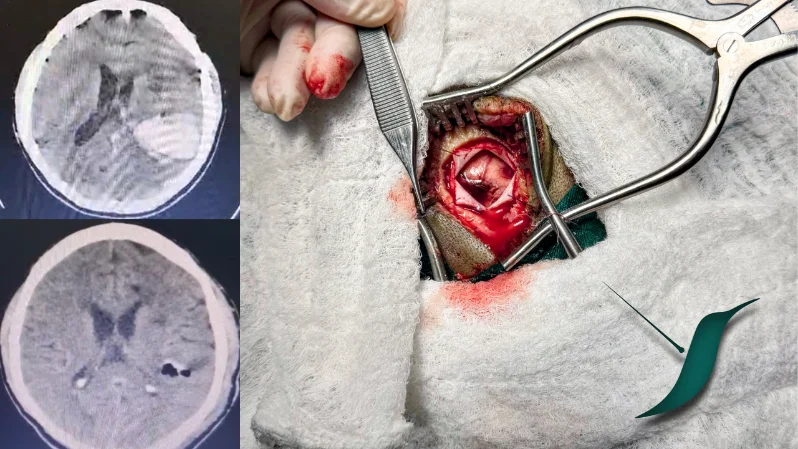 Evacuación de hematoma intracerebral por puerto de mínima invasión