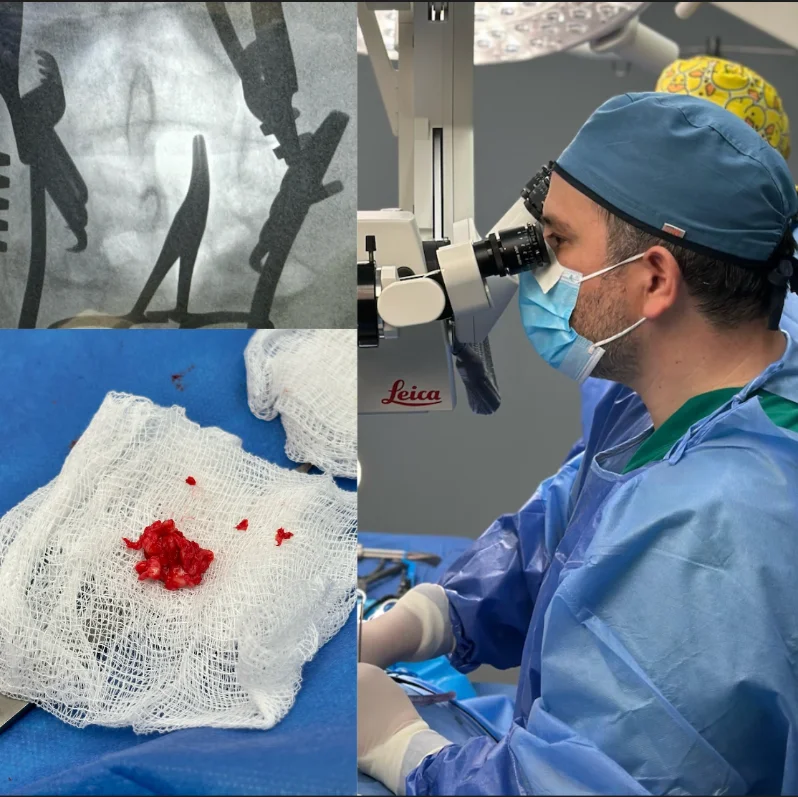 Microdiscectomía lumbar